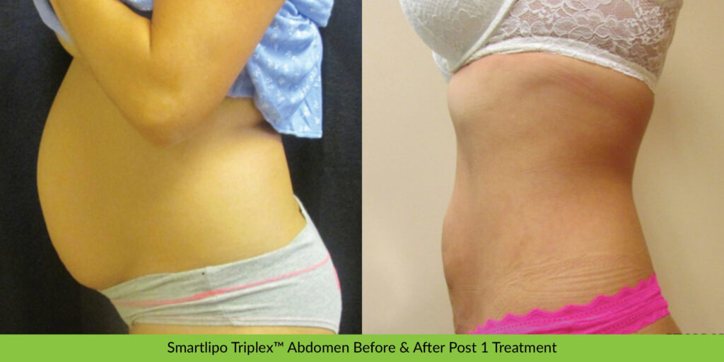 Before & After SmartLipo