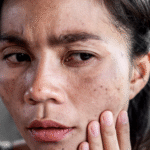 Melasma