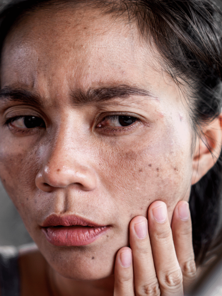 Melasma