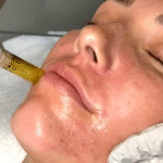 What is Microneedling and Why is it So Popular?