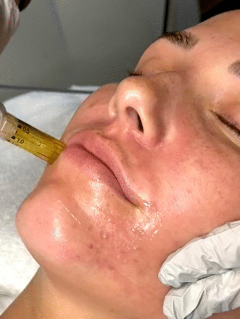 What is Microneedling and Why is it So Popular?